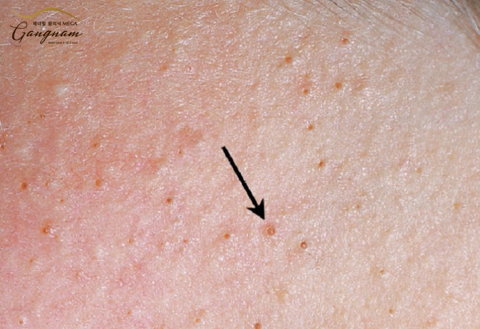 Một Lỗ Chân Lông Mọc 2 Sợi Lông: Nguyên Nhân và Điều Trị