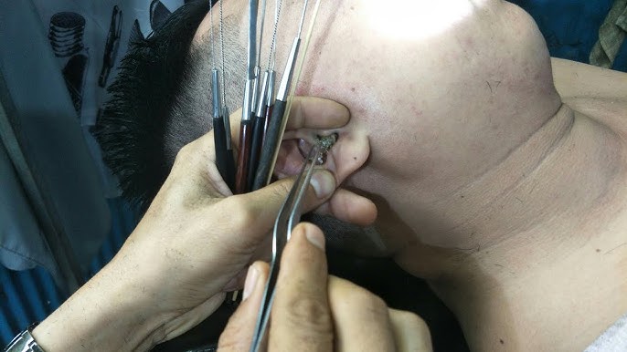 10 Năm Không Lấy Ráy Tai: Nguy Hiểm Hay An Toàn?