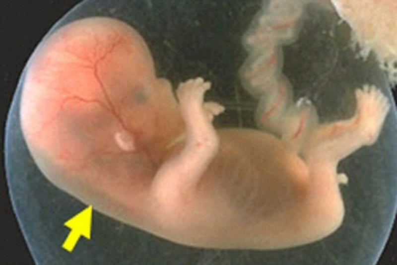 11 Tuần Đo Độ Mờ Da Gáy Được Chưa?