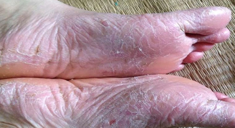 Á sừng ở chân