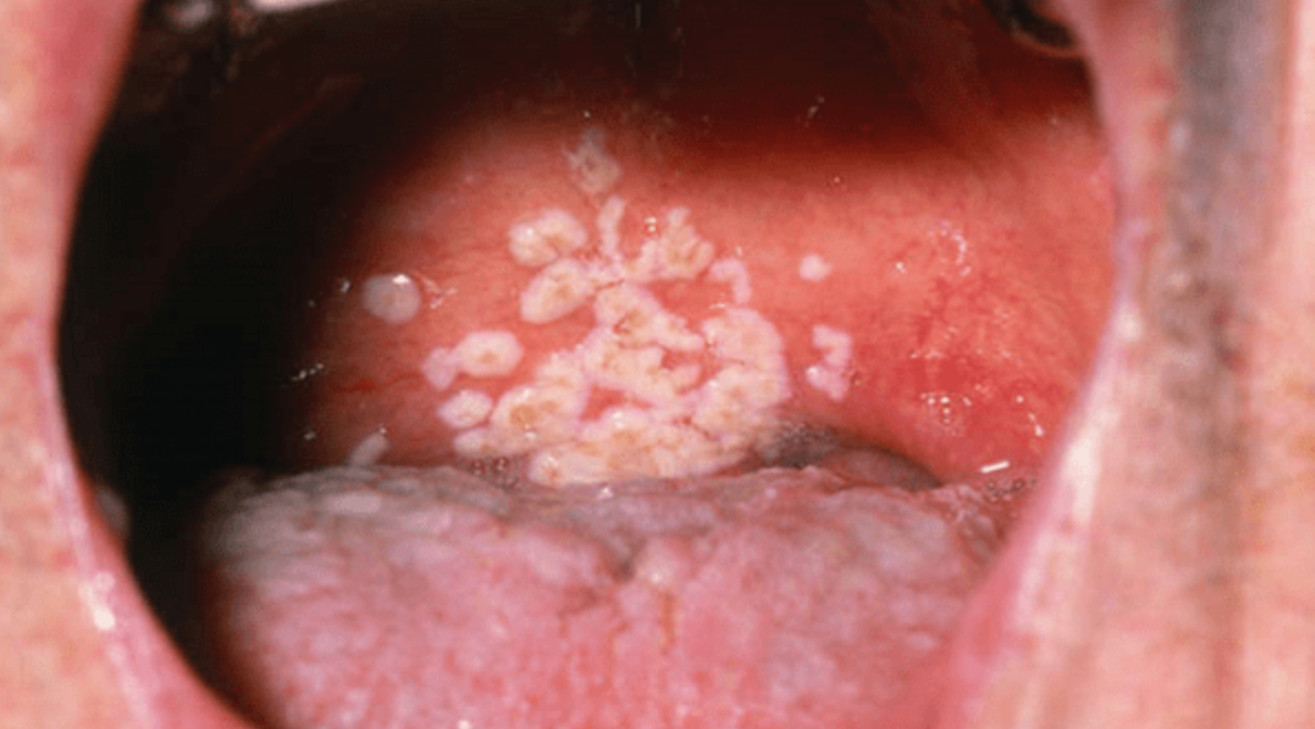 AIDS Giai Đoạn Cuối