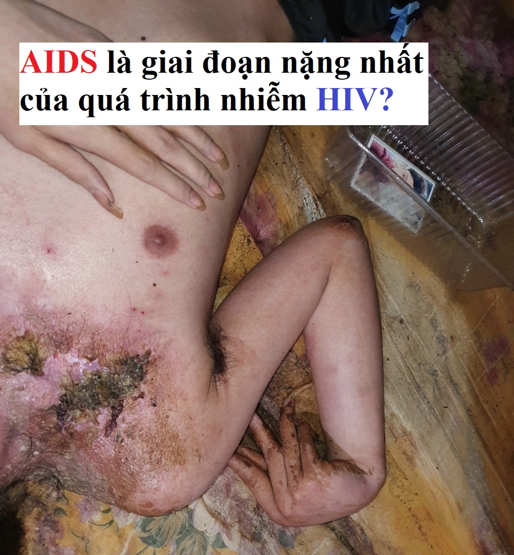 AIDS Giai Đoạn Cuối Sống Được Bao Lâu?