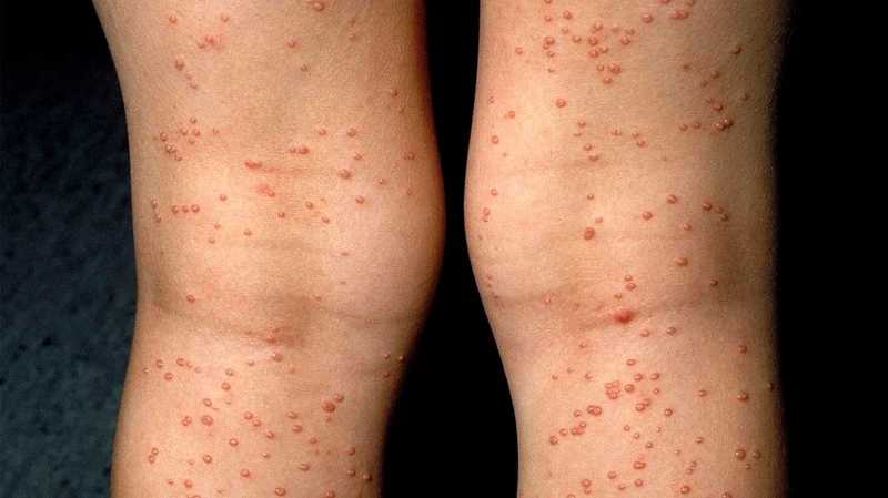 AIDS Giai Đoạn Cuối Sống Được Bao Lâu? Gallery 2