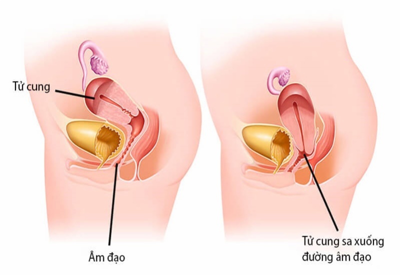 Âm đạo bị lồi: Nguyên nhân, triệu chứng và cách điều trị
