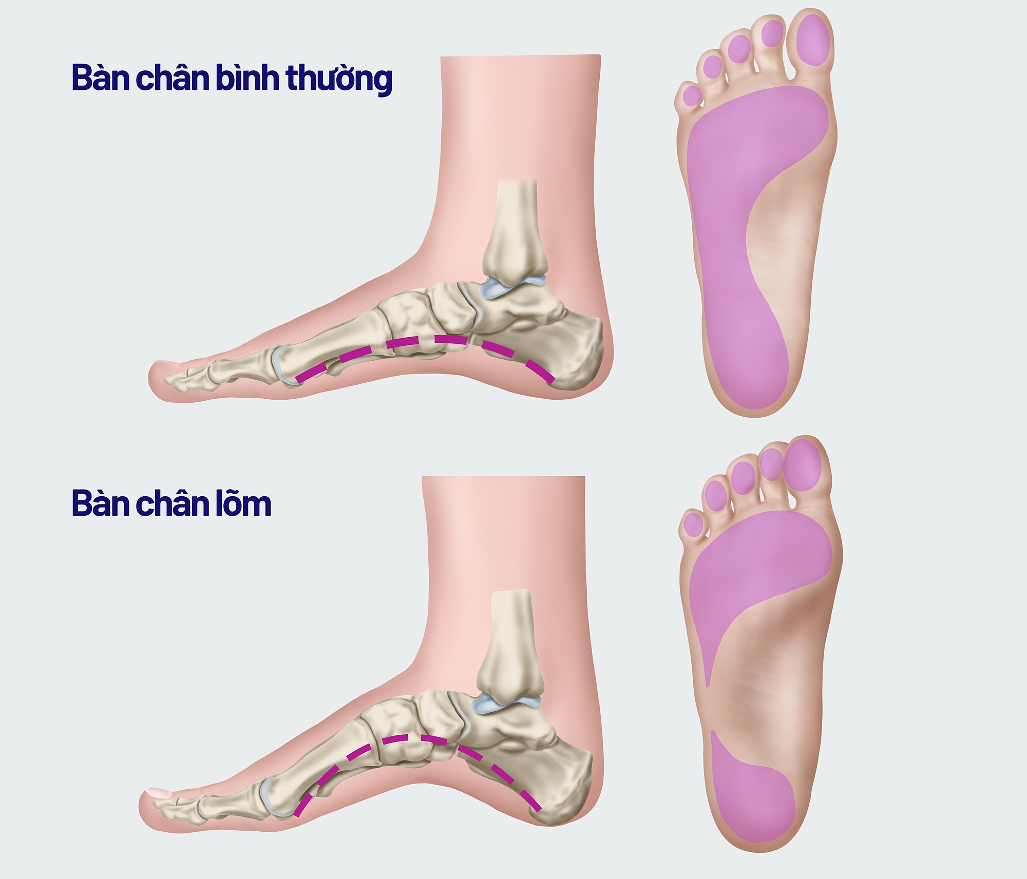 Bàn chân lõm thì khổ Gallery 2