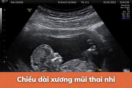 Chiều dài xương mũi ngắn có sao không? Gallery 2