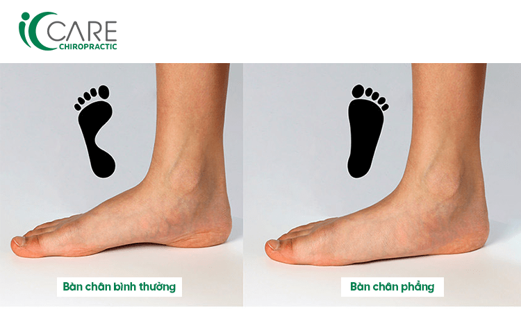 Lòng bàn chân bằng phẳng: Sướng hay khổ? Gallery 1