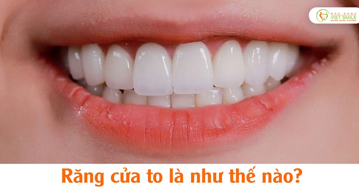 Răng cửa to sướng hay khổ? Gallery 1