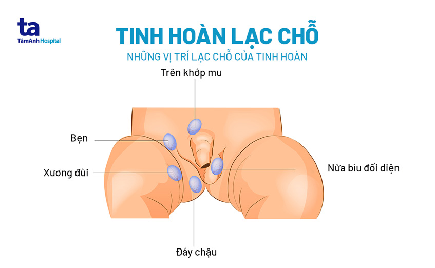 Teo một bên tinh hoàn có sinh con được không? Gallery 1