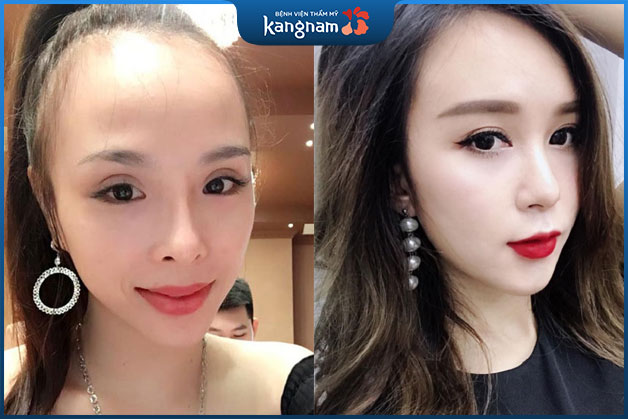 Trán Cao và Trán Dô: Khám Phá Đặc Điểm và Ý Nghĩa Gallery 2