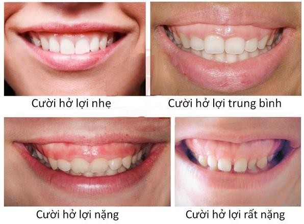 Phụ nữ cười hở lợi tốt hay xấu? Gallery 1
