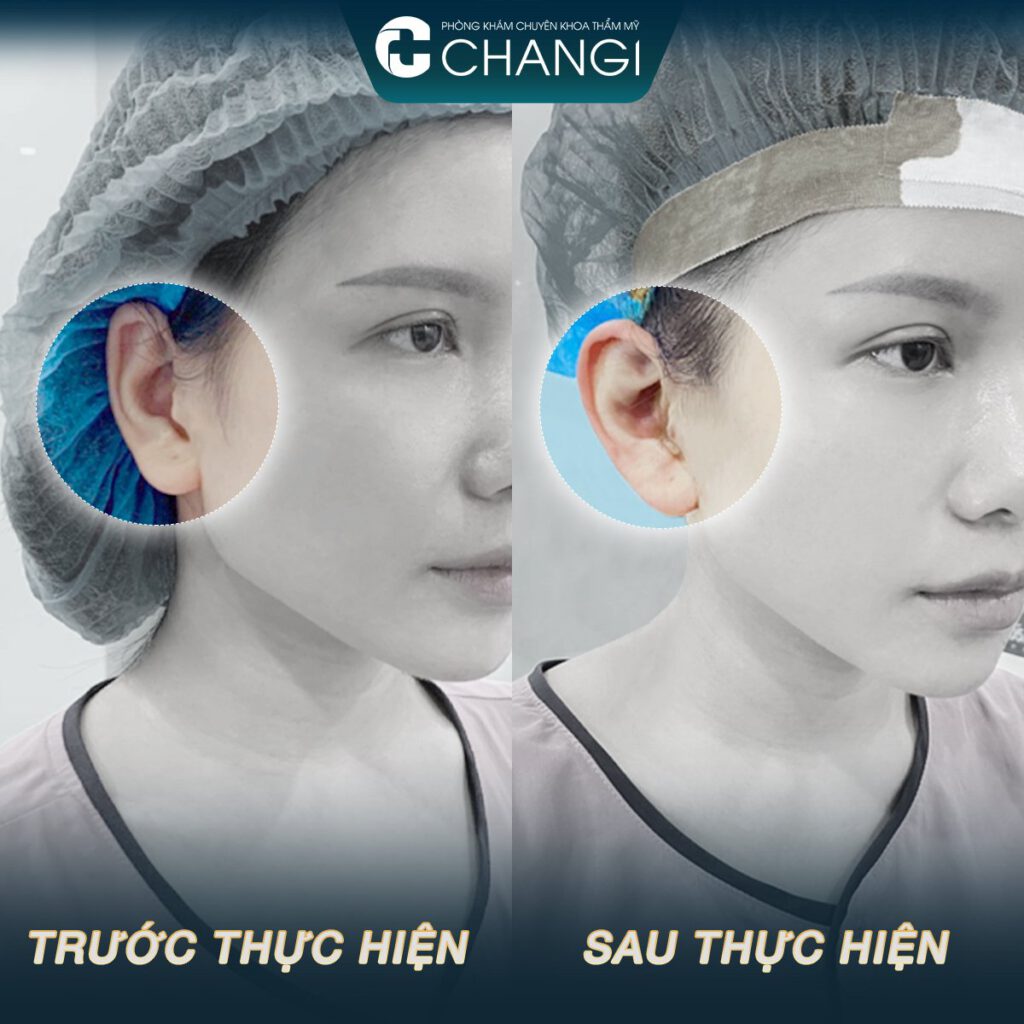 Tai Vểnh Có Tốt Không? Gallery 2