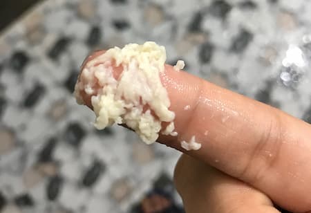 Bã trắng ở vùng kín: Nguyên nhân và cách xử lý