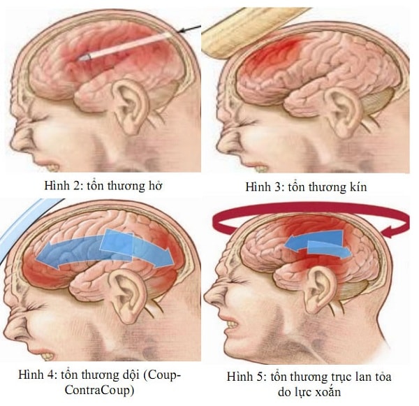 Bài Giảng Chấn Thương Sọ Não