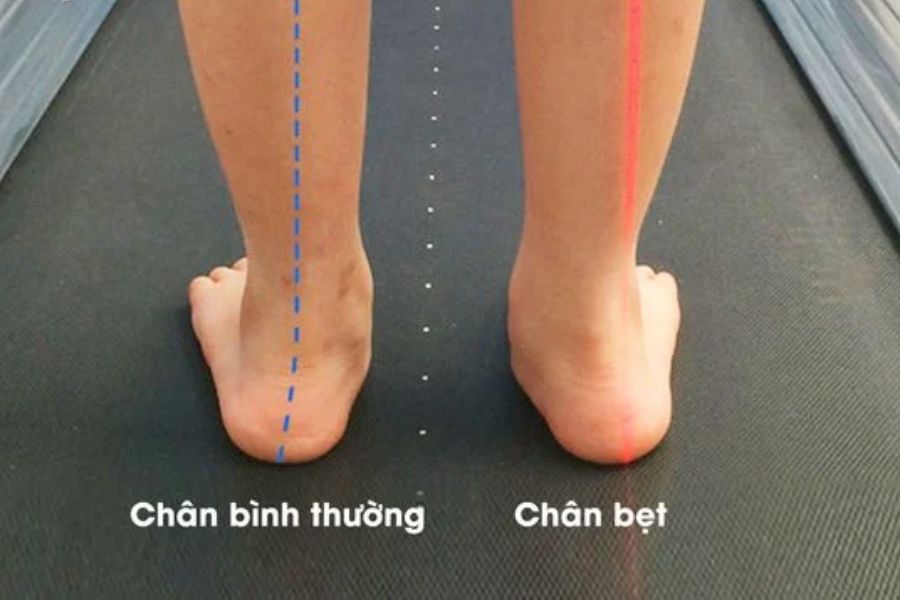 Bàn chân bẹt có nguy hiểm không? Gallery 2