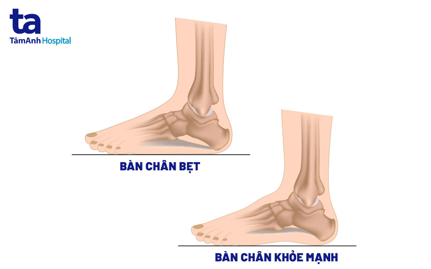 Bàn Chân Bẹt Ở Người Lớn