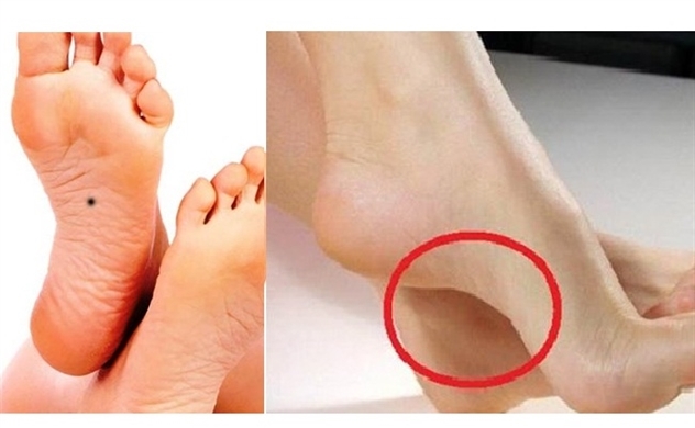 Bàn chân lõm thì khổ