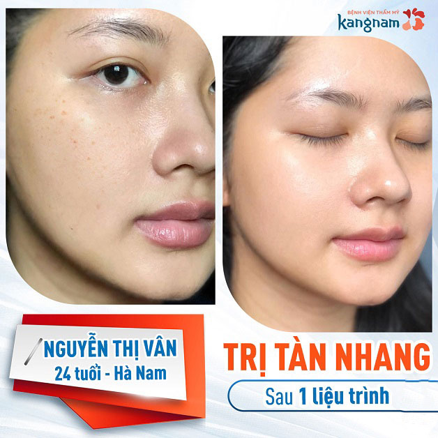 Bắn tàn nhang bao nhiêu tiền?