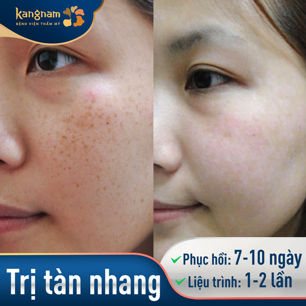 Bắn tàn nhang ở đâu?