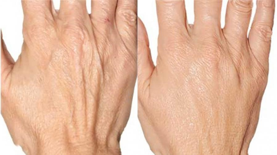 Bàn Tay Nhăn Nheo: Nguyên Nhân, Triệu Chứng Và Cách Khắc Phục