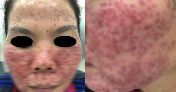 Banh Chành Là Gì?