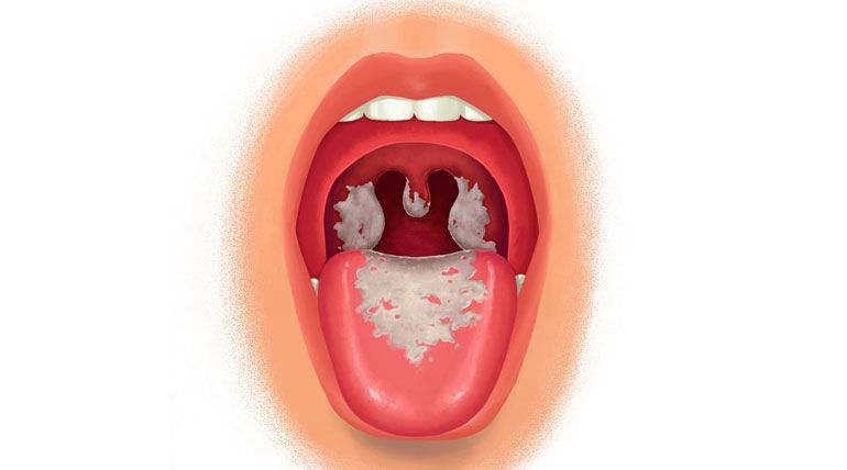 Bệnh bạch hầu là gì?