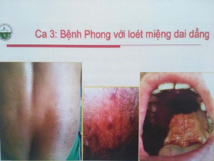 Hàn Mặc Tử bị bệnh gì? Gallery 1