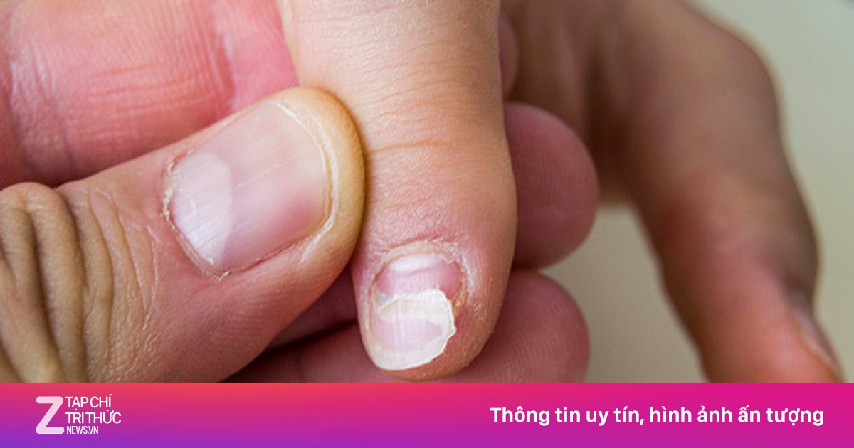 Bị Bong Móng Chân: Nguyên Nhân, Điều Trị và Phòng Ngừa