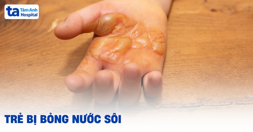 Bị bỏng nước sôi bao lâu thì khỏi?