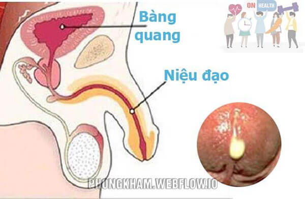 Chảy mủ ở bộ phận sinh dục nam: Nguyên nhân, triệu chứng và cách điều trị