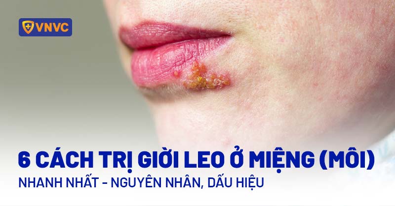 Bị Dời Ở Miệng: Nguyên Nhân, Triệu Chứng Và Cách Điều Trị