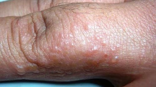 Bị ghẻ nước phải làm sao?
