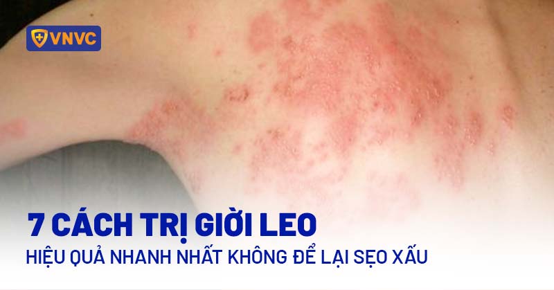 Bị Giời Leo Nên Làm Gì?