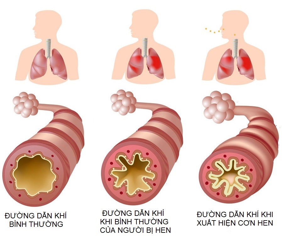 Bị Hen Suyễn Là Gì?