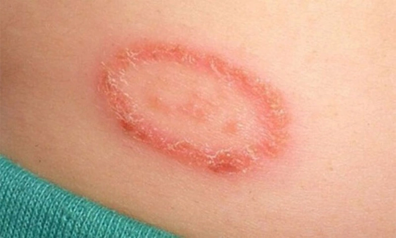 Bị lác đồng tiền làm sao hết?