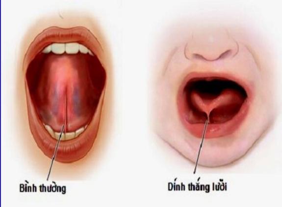 Bị Ngọng Là Gì?