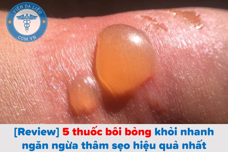 Bị phỏng nên bôi gì?