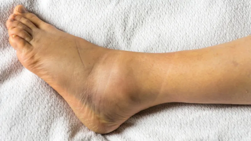 Bị Rạn Xương Mắt Cá Chân: Nguyên Nhân, Triệu Chứng, Điều Trị và Phục Hồi