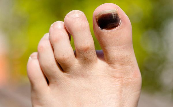 Bị vật nặng rơi vào ngón chân cái: Cách xử lý và phòng ngừa