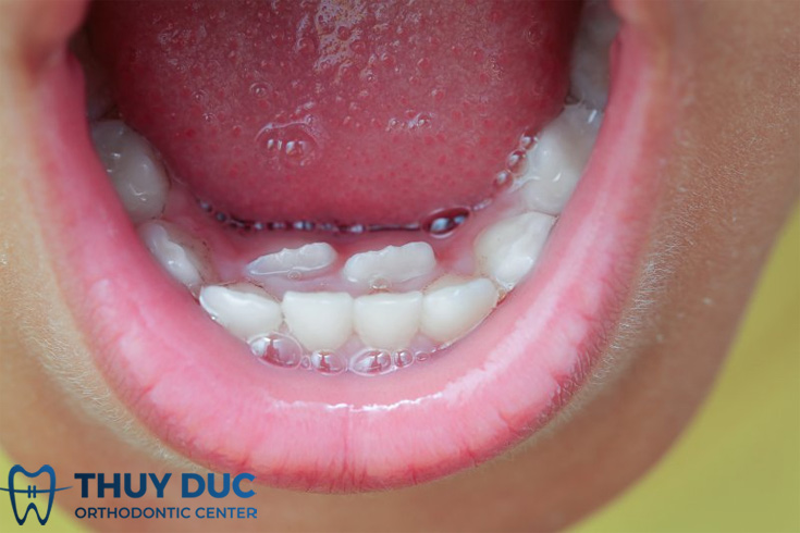 Răng Chưa Rụng Răng Mới Đã Mọc: Nguyên Nhân, Biện Pháp Khắc Phục và Khi Nào Cần Đi Khám Nha Khoa Gallery 2