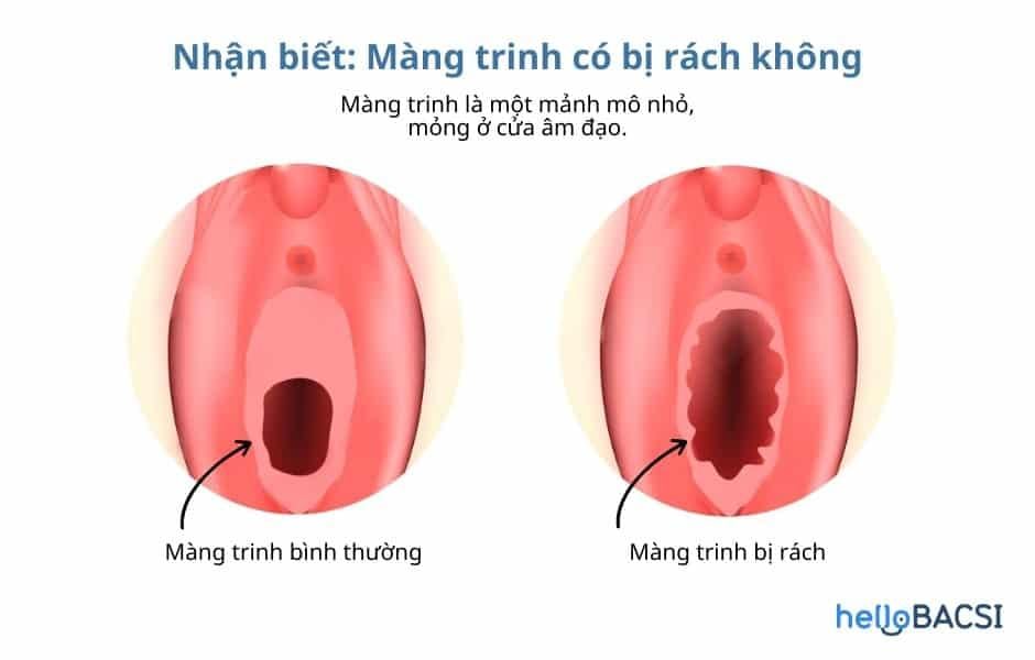 Biểu Hiện Của Rách Màng Trinh