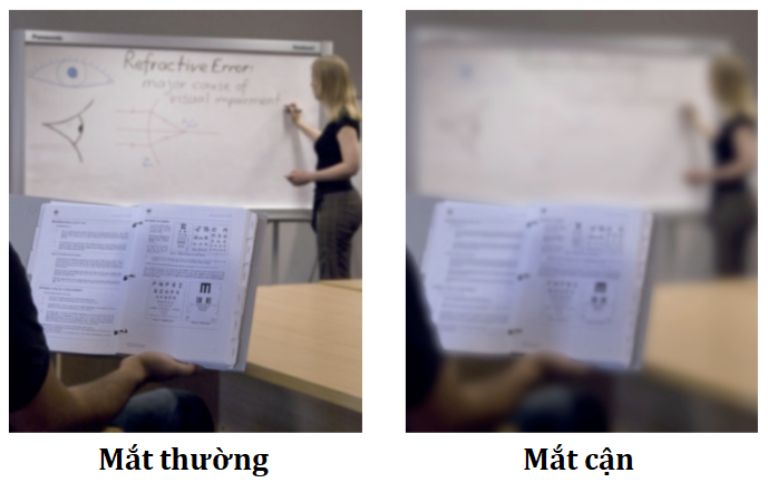 Biểu Hiện Cận Thị