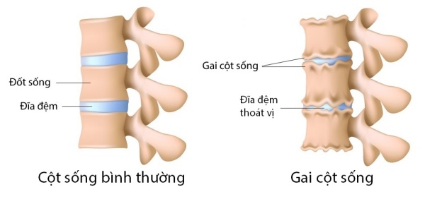 Biểu Hiện Gai Cột Sống: Nhận Biết Dấu Hiệu Sớm & Phương Pháp Điều Trị