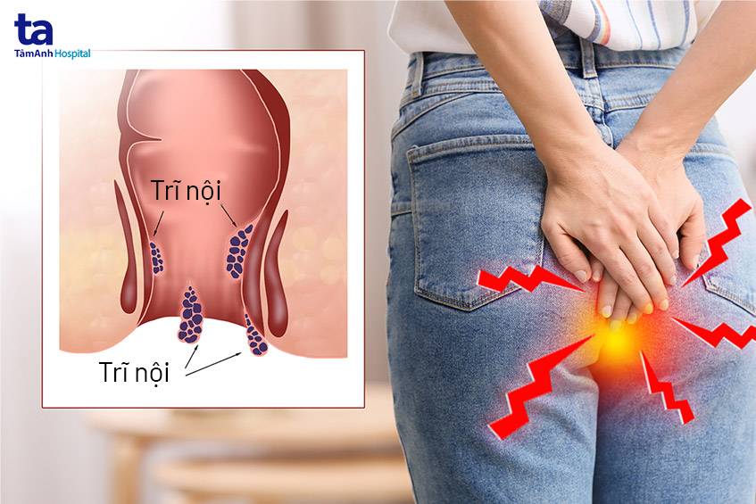 Biểu Hiện Trĩ Nội: Nhận Biết Và Điều Trị Kịp Thời