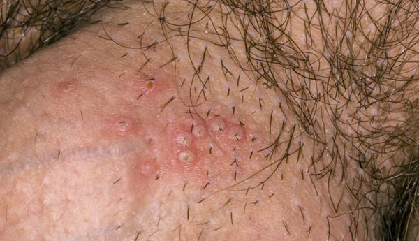 Bộ phận sinh dục nam bị ngứa nổi mẩn đỏ: Nguyên nhân và cách điều trị