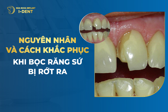 Bọc răng sứ có bị rơi ra không?