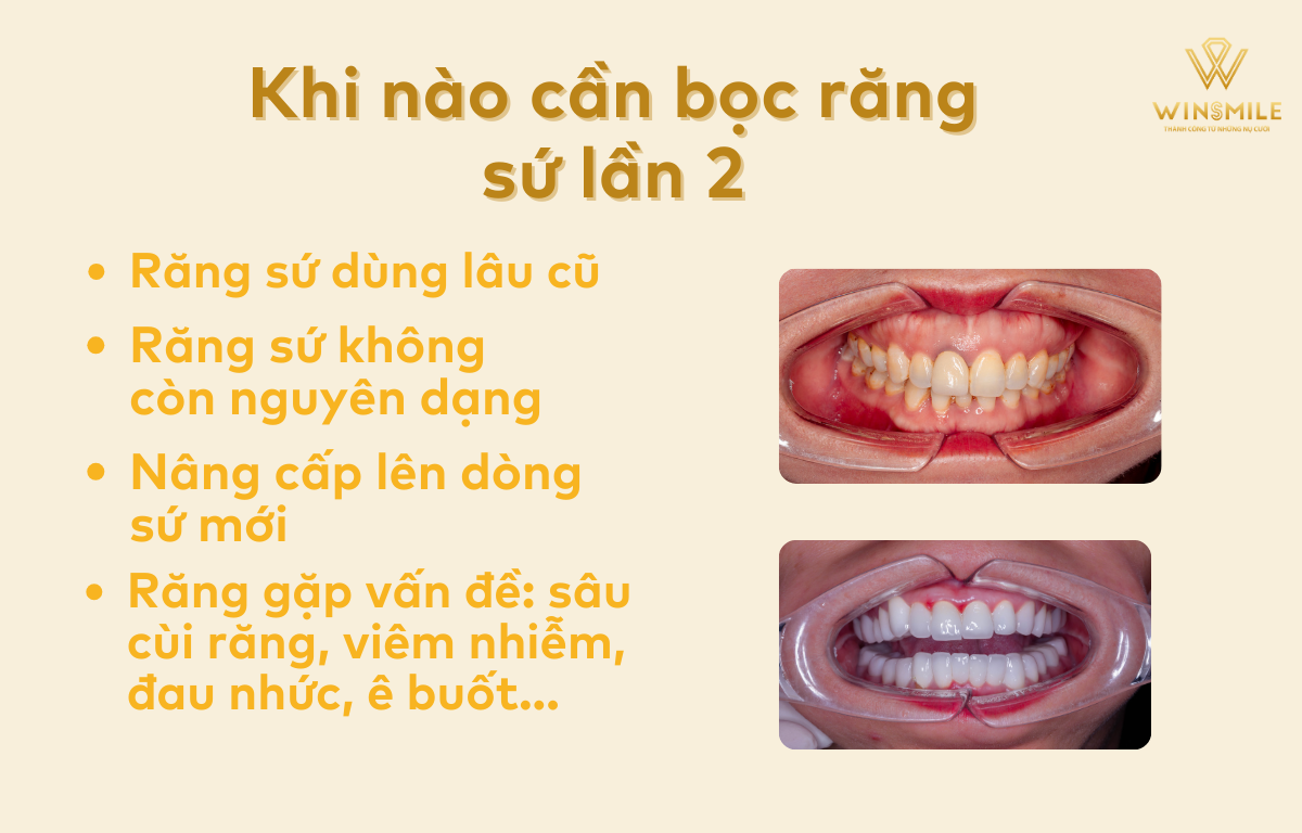Bọc Răng Sứ Lần 2: Khi Nào Cần & Những Điều Cần Biết