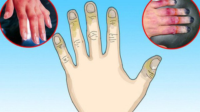 Bỏng ớt ở tay: Cách xử lý nhanh chóng và hiệu quả