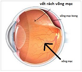 Bong võng mạc là gì?