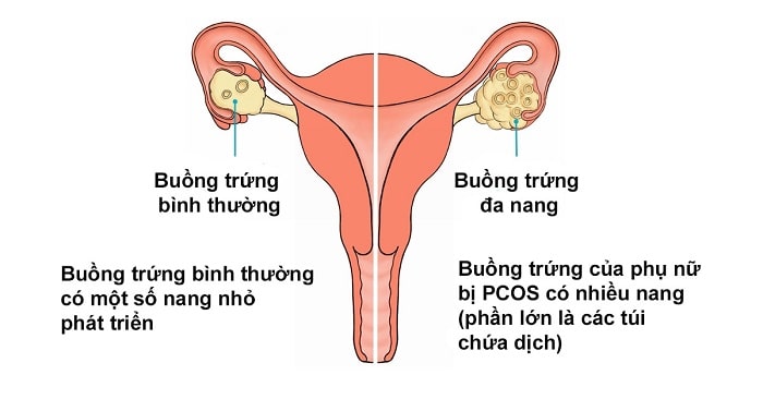Buồng Trứng Nhiều Nang Nhỏ: Nguyên Nhân, Triệu Chứng Và Điều Trị